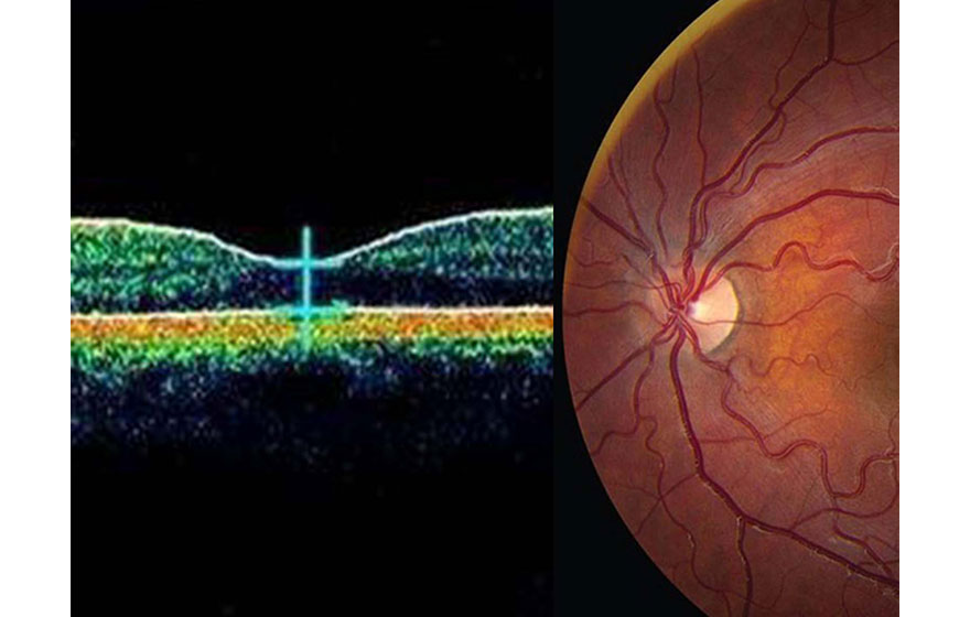 Ophthalmic Imaging